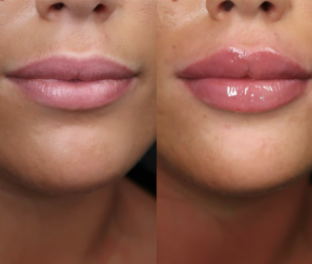 Lip boosting