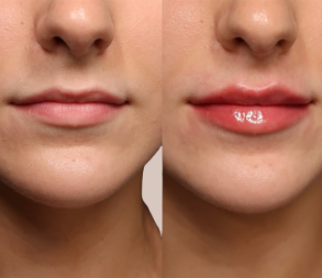 Lip boosting